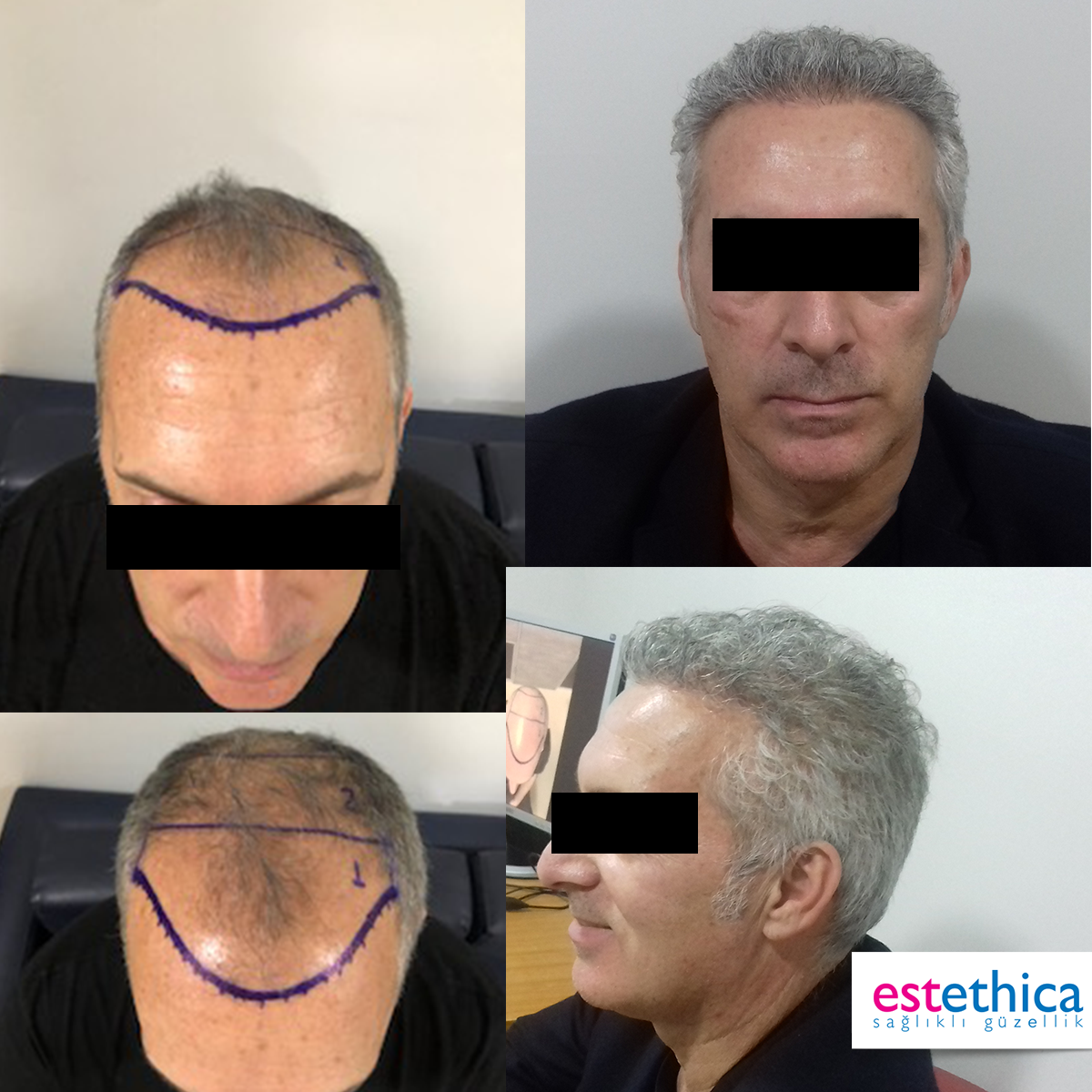 Hårtransplantation resultat