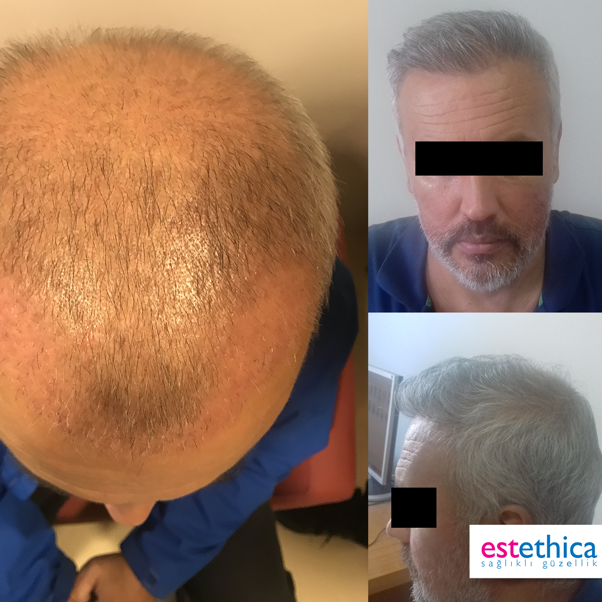 Hårtransplantation resultat