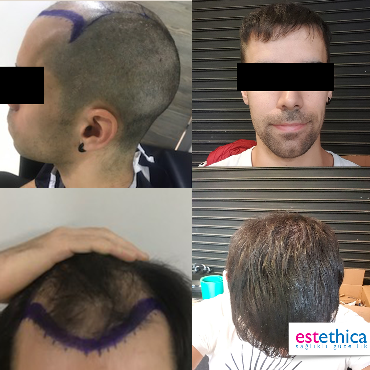 Hårtransplantation resultat