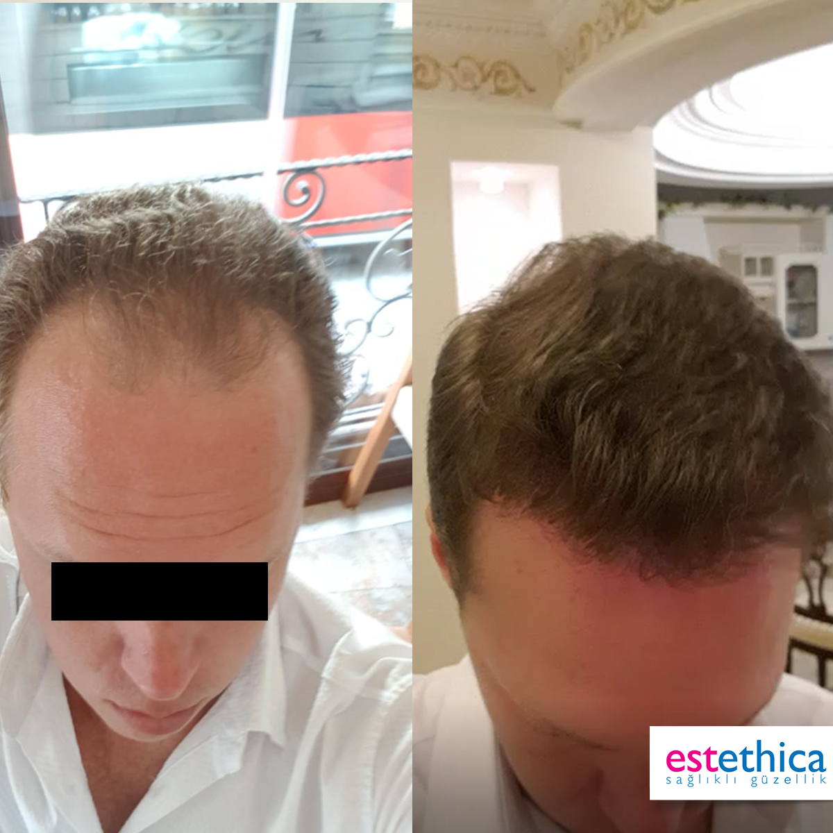 Hårtransplantation resultat