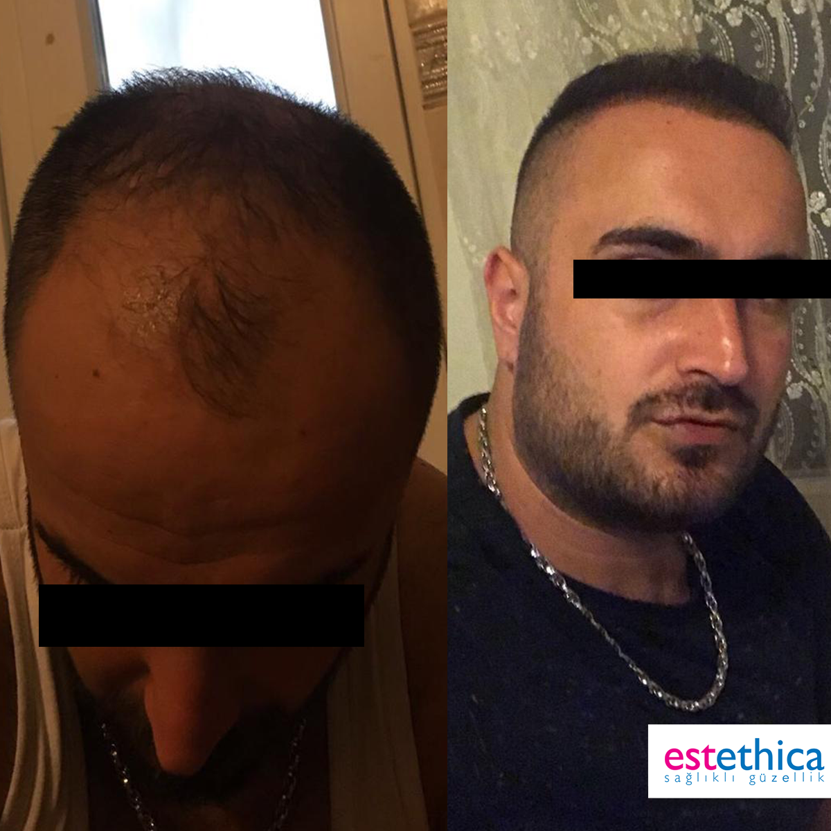 Hårtransplantation resultat