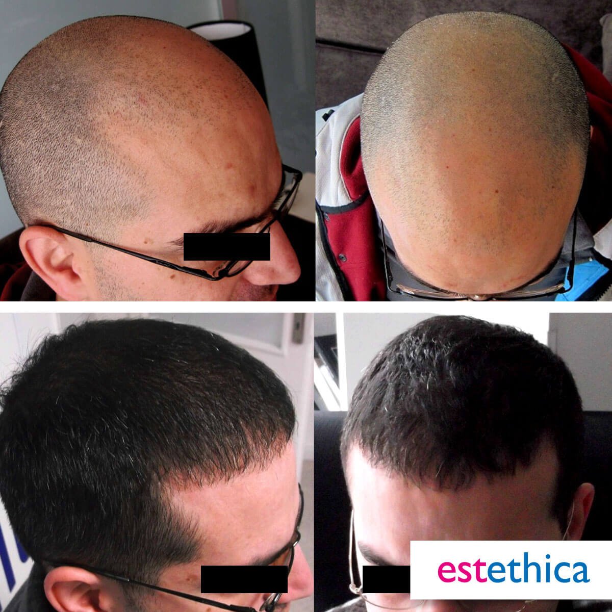 Hårtransplantation resultat - Tät coverage