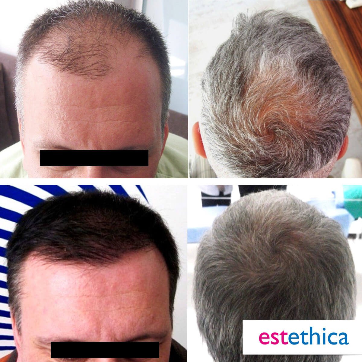 Hårtransplantation resultat - Naturlig hårlinje