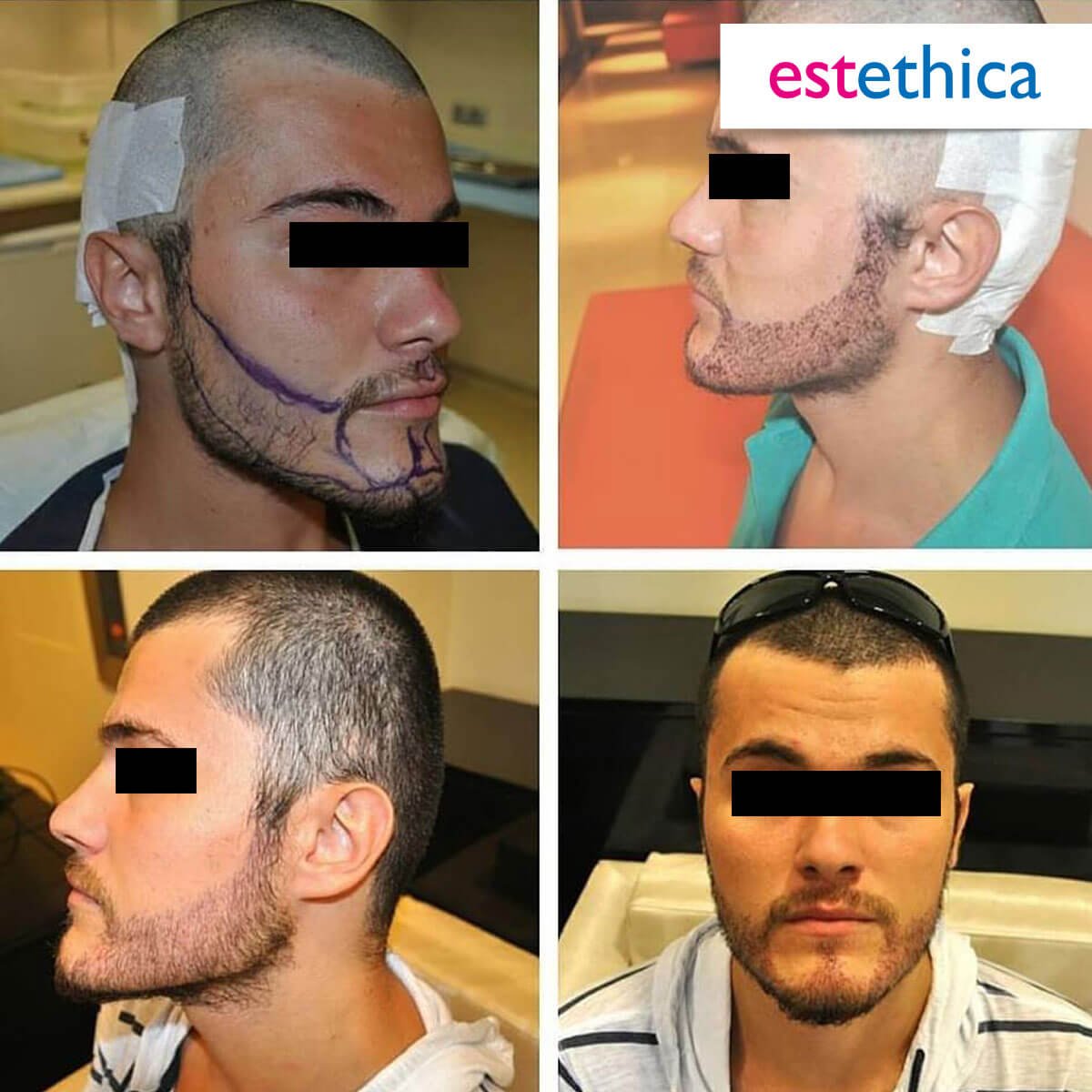 Hårtransplantation resultat - Framhårlinje